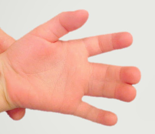 Alterações congênitas nas mãos quais são e como tratar