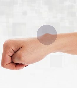 o que causa um cisto sinovial