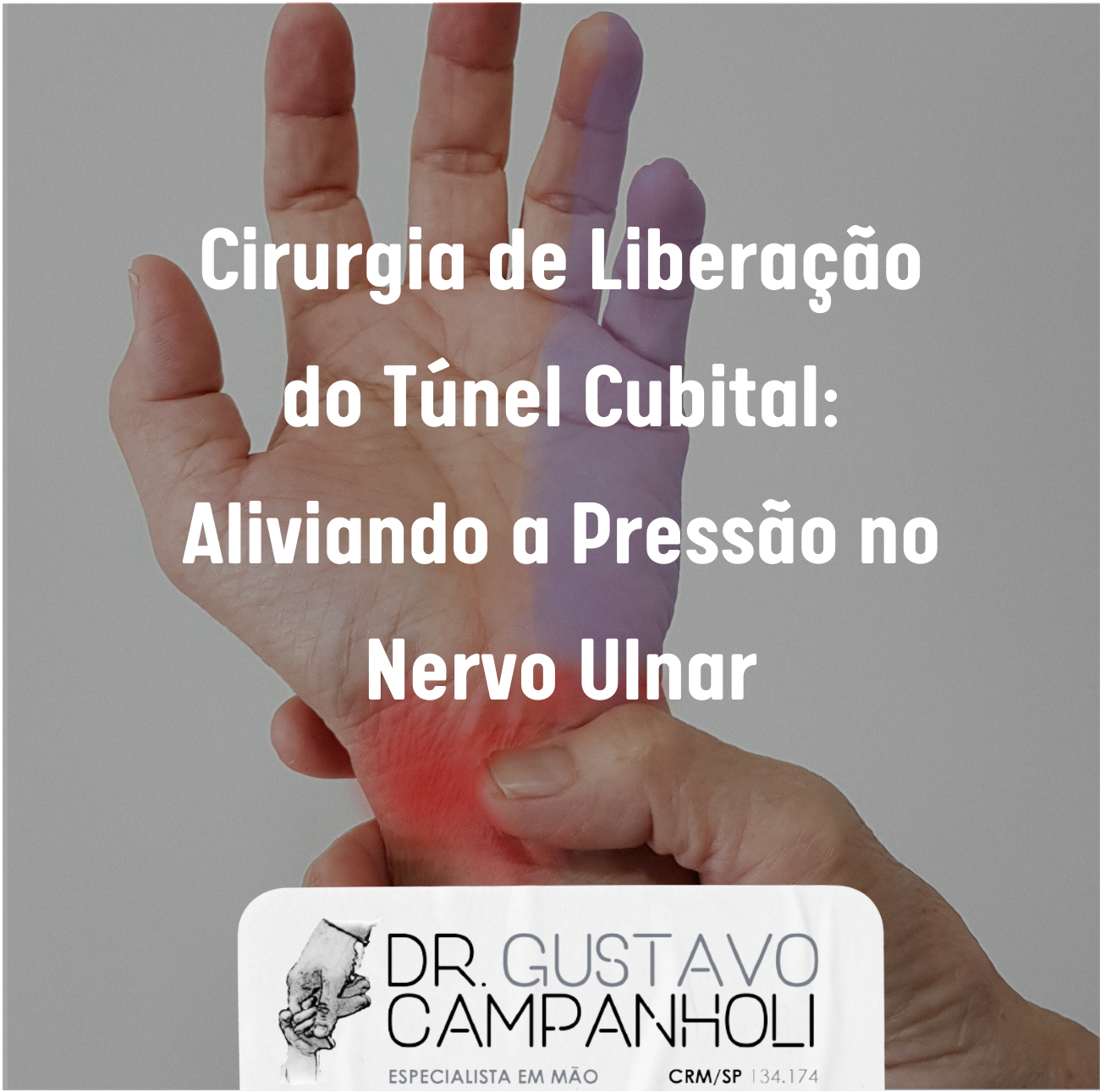 Cirurgia de Liberação do Túnel Cubital Aliviando a Pressão no Nervo Ulnar